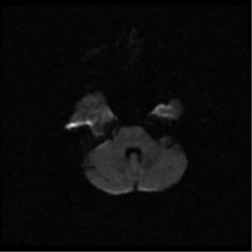 File:Anterior cerebral artery territory infarct (Radiopaedia 39327-41584 Axial DWI 6).png