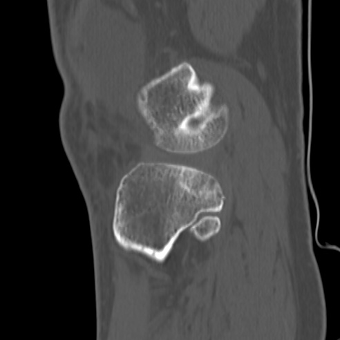 File:Anterior cruciate ligament avulsion fracture (Radiopaedia 58939-66194 Sagittal bone window 7).jpg