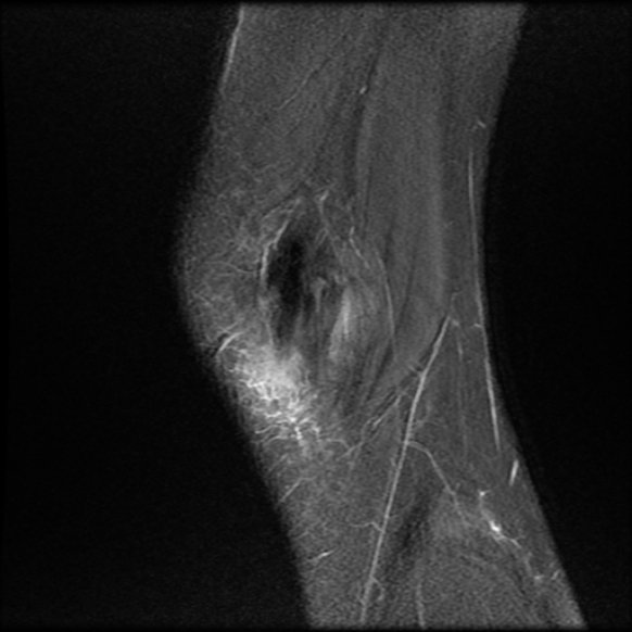 File:Anterior cruciate ligament graft tear and bucket-handle tear of medial meniscus (Radiopaedia 75867-87255 Sagittal PD fat sat 2).jpg