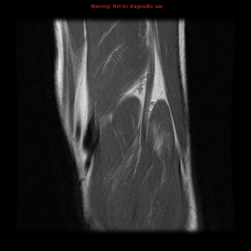 File:Anterior cruciate ligament injury - partial thickness tear (Radiopaedia 12176-12515 Coronal PD 19).jpg