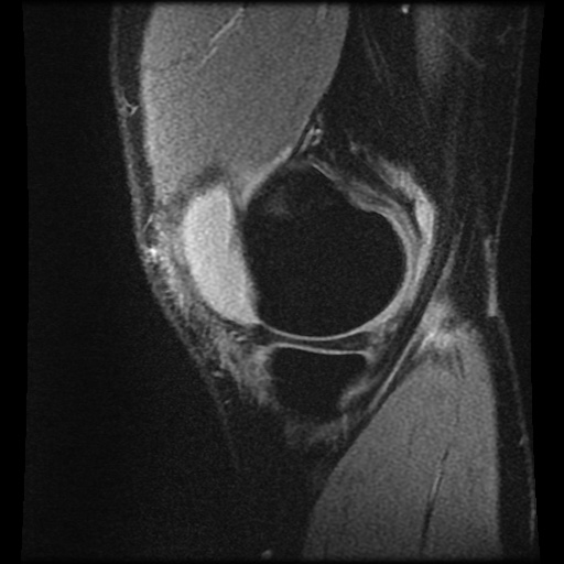 File:Anterior cruciate ligament tear (Radiopaedia 61500-69462 F 11).jpg