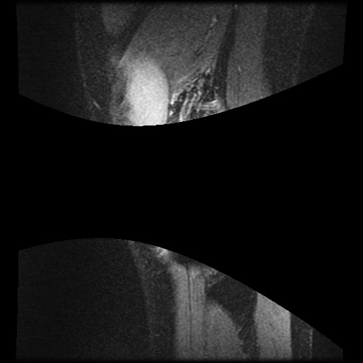 Anterior cruciate ligament tear (Radiopaedia 61500-69462 F 84).jpg