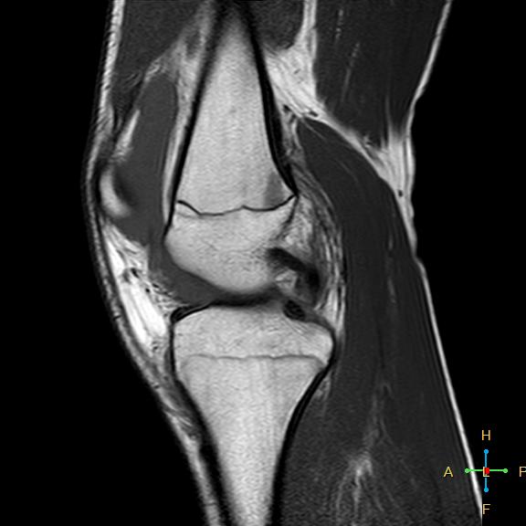 File:Anterior cruciate ligament tear - complete (Radiopaedia 24907-25170 Sagittal T1 11).jpg
