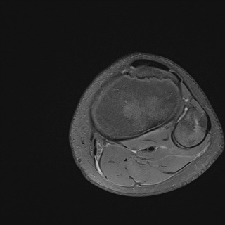File:Anterior cruciate ligament tear - pediatric (Radiopaedia 62152-70260 Axial PD fat sat 34).jpg