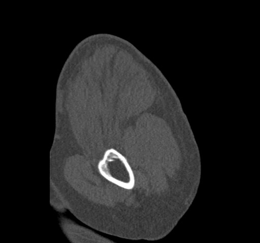 File:Anterior glenohumeral dislocation with Hill-Sachs lesion (Radiopaedia 62877-71249 Sagittal bone window 10).jpg