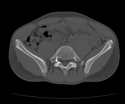 Anterior inferior iliac spine avulsion fracture (Radiopaedia 81312-94999 Axial bone window 20).jpg