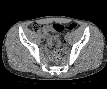 File:Anterior inferior iliac spine avulsion fracture (Radiopaedia 81312-94999 Axial non-contrast 38).jpg