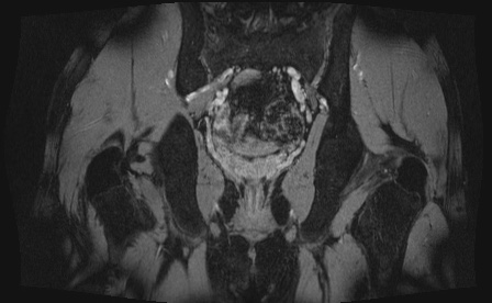Anterior inferior iliac spine avulsion fracture (Radiopaedia 81312-95000 G 11).jpg