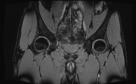 Anterior inferior iliac spine avulsion fracture (Radiopaedia 81312-95000 G 58).jpg