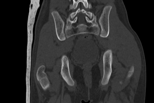 Anterior inferior iliac spine avulsion injury (Radiopaedia 88666-105376 Coronal bone window 50).jpg
