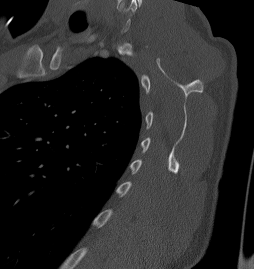 Anterior shoulder dislocation with Hill-Sachs and bony Bankart lesions (Radiopaedia 40424-42974 Sagittal bone window 46).png