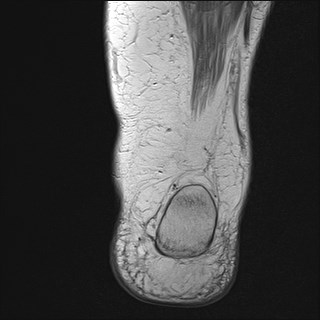 File:Anterior talofibular ligament injury - rupture with soft-tissue impingement (Radiopaedia 38765-40928 Coronal PD 5).jpg