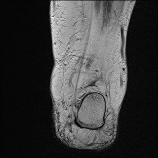 File:Anterior talofibular ligament injury - rupture with soft-tissue impingement (Radiopaedia 38765-40928 Coronal T2 7).jpg