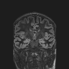 Anterior temporal encephalocele (Radiopaedia 82624-96808 Coronal FLAIR 25).jpg