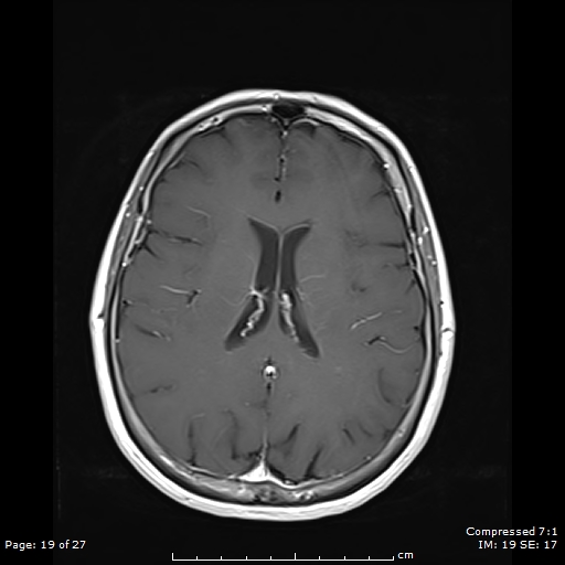 File:Anterior temporal lobe perivascular space (Radiopaedia 88283-104914 Axial T1 C+ 19).jpg