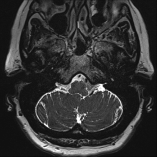 Anterior temporal pole cysts (Radiopaedia 46629-51102 Axial T2 17).png