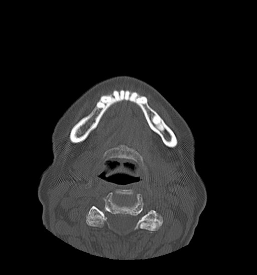 Anterior temporomandibular joint dislocation (Radiopaedia 59430-66784 Axial non-contrast 51).jpg