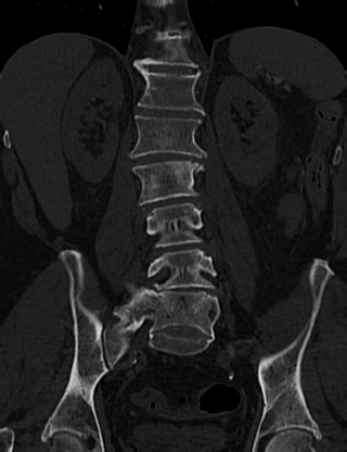 Anterior vertebral scalloping (abdominal aortic aneurysm) (Radiopaedia 66744-76067 Coronal bone window 40).jpg