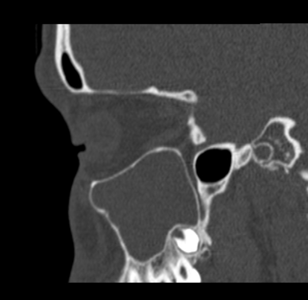 Antrochoanal polyp (Radiopaedia 33984-35202 Sagittal bone window 22).jpg
