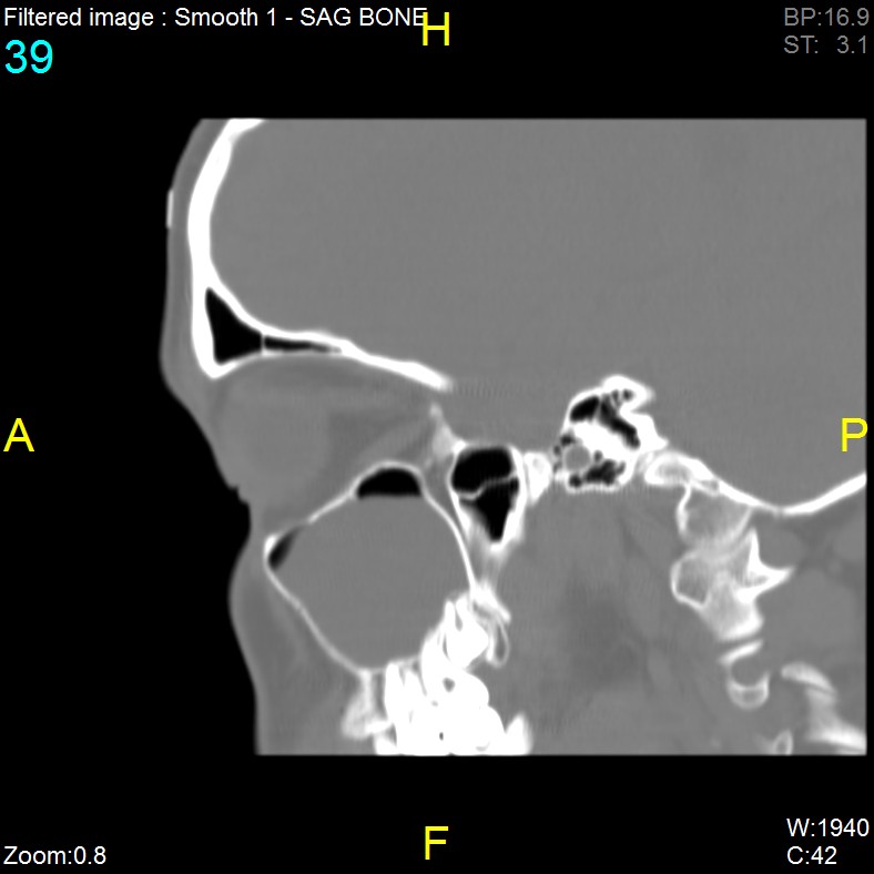 Antrochoanal polyp (Radiopaedia 65101-74094 Sagittal bone window 39).jpg