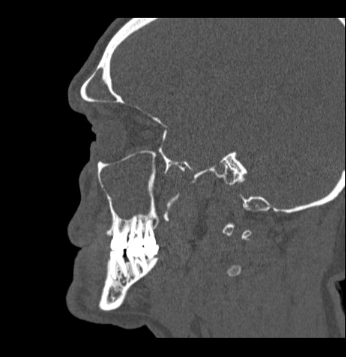 Antrochoanal polyp (Radiopaedia 79011-92169 Sagittal bone window 57).jpg