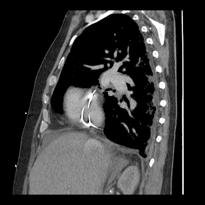 Aortic arch graft infection (FDG PET-CT) (Radiopaedia 71975-82437 C 22).jpg