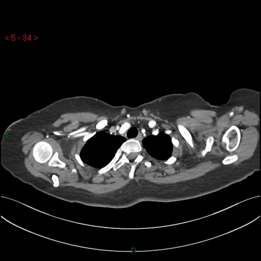 File:Aortic arch origin of left vertebral artery (Radiopaedia 51520-57286 A 33).jpg