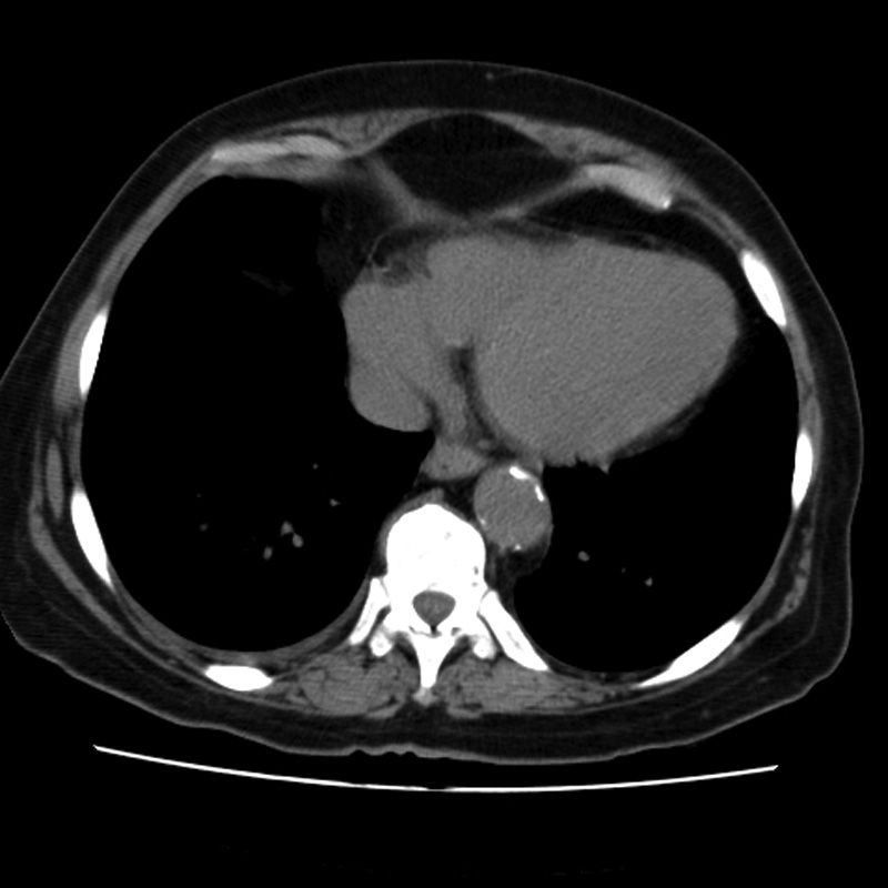 Aortic arch pseudoaneurysm (Radiopaedia 8534-9368 Axial non-contrast 54).jpg