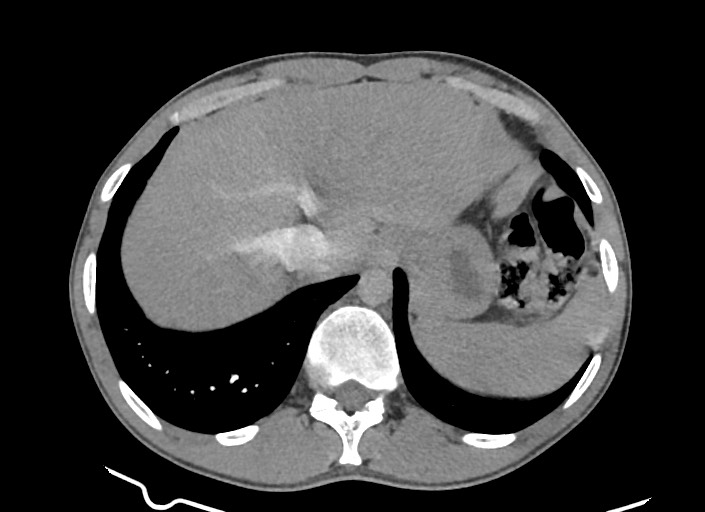File:Aortic coarctation with aneurysm (Radiopaedia 74818-85828 A 45).jpg