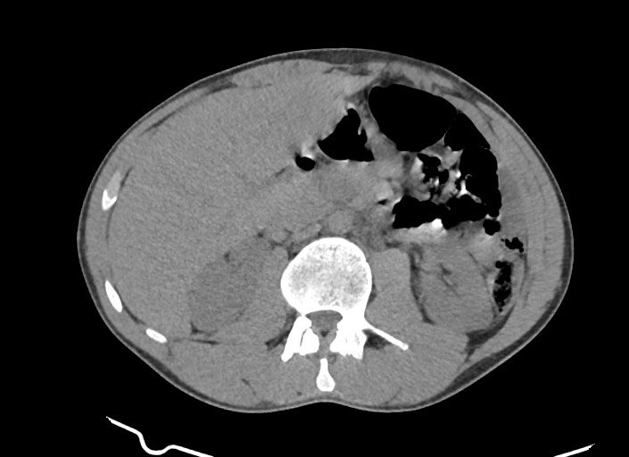 File:Aortic coarctation with aneurysm (Radiopaedia 74818-85828 A 9).jpg