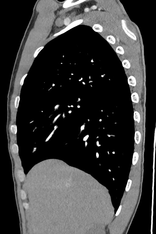 Aortic coarctation with aneurysm (Radiopaedia 74818-85828 B 44).jpg