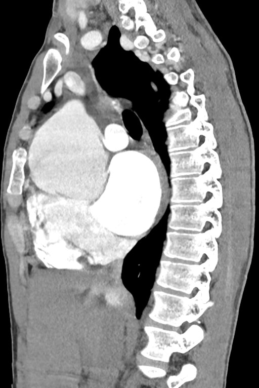 Aortic coarctation with aneurysm (Radiopaedia 74818-85828 B 74).jpg