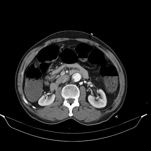 Aortic dissection- Stanford type A (Radiopaedia 22085-22085 A 49).jpg