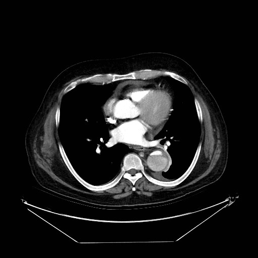 Aortic dissection (Radiopaedia 62562-71000 A 24).jpg