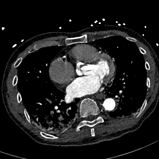 File:Aortic dissection - DeBakey type II (Radiopaedia 64302-73082 A 58).png