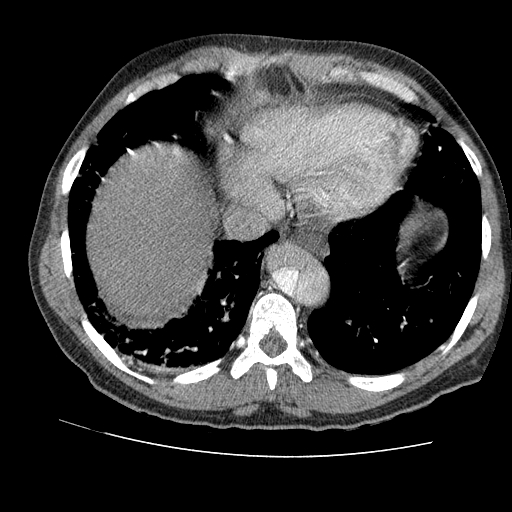 File:Aortic dissection - Stanford A -DeBakey I (Radiopaedia 28339-28587 B 80).jpg