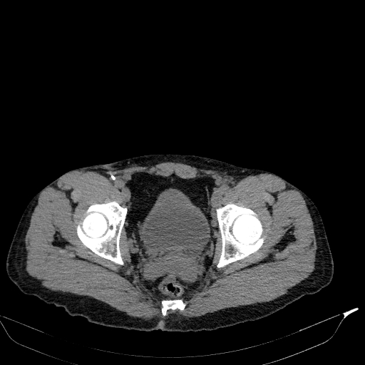 Aortic dissection - Stanford type A (Radiopaedia 83418-98500 Axial non-contrast 87).jpg
