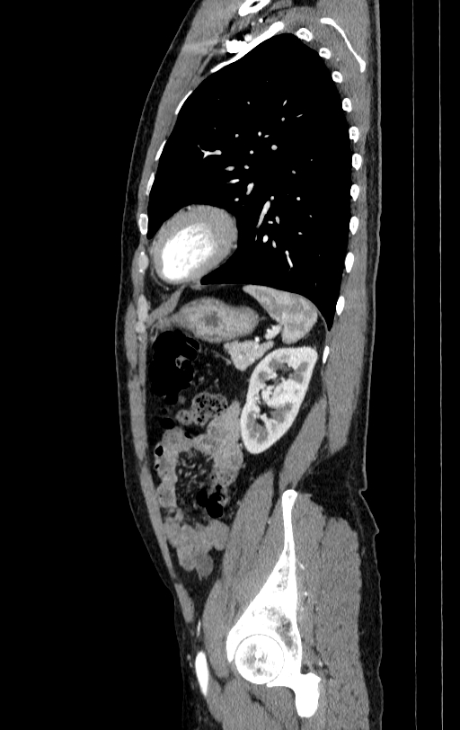 Aortic dissection - Stanford type A (Radiopaedia 83418-98500 B 79).jpg