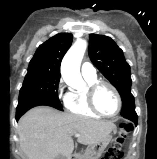 Aortic dissection - Stanford type B (Radiopaedia 50171-55512 B 25).png