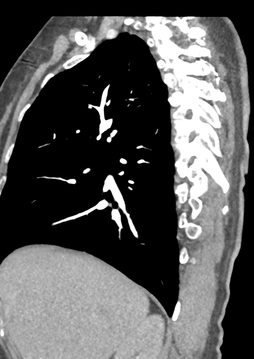Aortic dissection - Stanford type B (Radiopaedia 50171-55512 C 49).png
