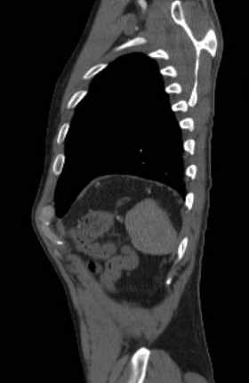 File:Aortic dissection - Stanford type B (Radiopaedia 73648-84437 C 19).jpg