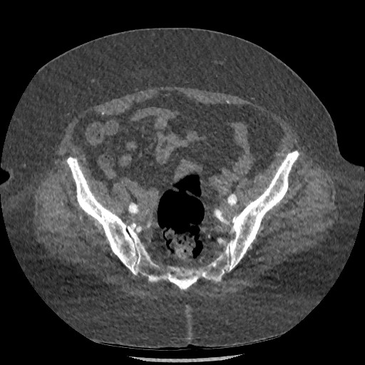 File:Aortic dissection - Stanford type B (Radiopaedia 88281-104910 A 146).jpg
