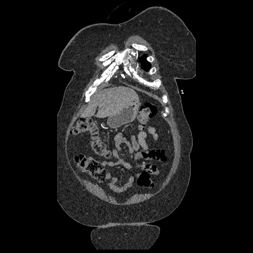 File:Aortic dissection - Stanford type B (Radiopaedia 88281-104910 B 7).jpg