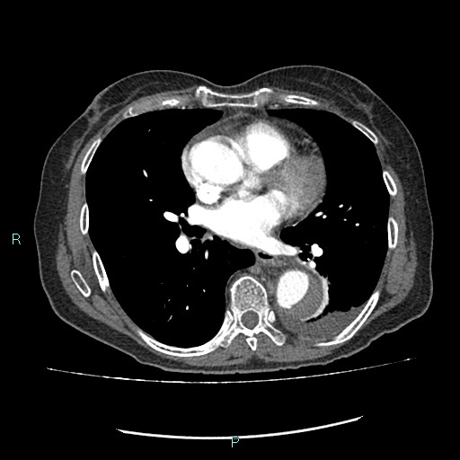 File:Aortic dissection extended to lusory artery (Radiopaedia 43686-47136 B 8).jpg
