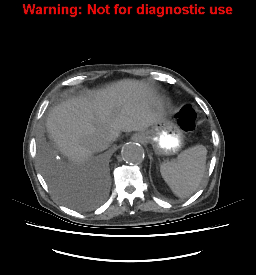 Aortic graft infection (Radiopaedia 44979-48907 Axial non-contrast 22).jpg