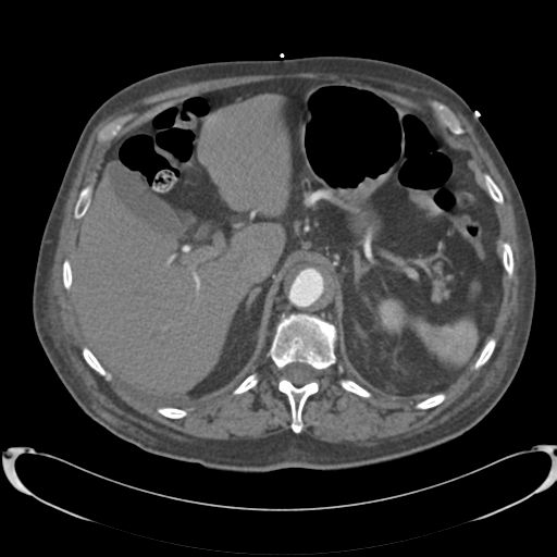 Aortic intramural hematoma (Radiopaedia 34260-35540 B 43).png