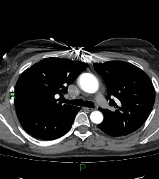 File:Aortic valve endocarditis (Radiopaedia 87209-103485 C 36).jpg