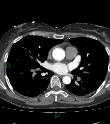 Aortic valve endocarditis (Radiopaedia 87209-103485 C 49).jpg