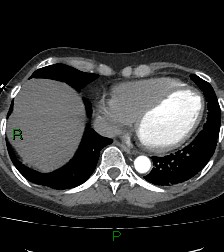 Aortic valve endocarditis (Radiopaedia 87209-103485 C 70).jpg