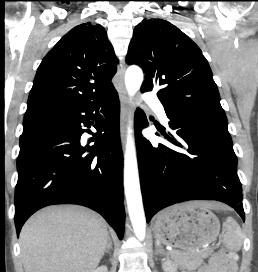 File:Aortic valve non-coronary cusp thrombus (Radiopaedia 55661-62189 C 48).png